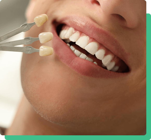 Are you conscious of gaps between your teeth? Do you want a cost effective smile makeover in one visit?