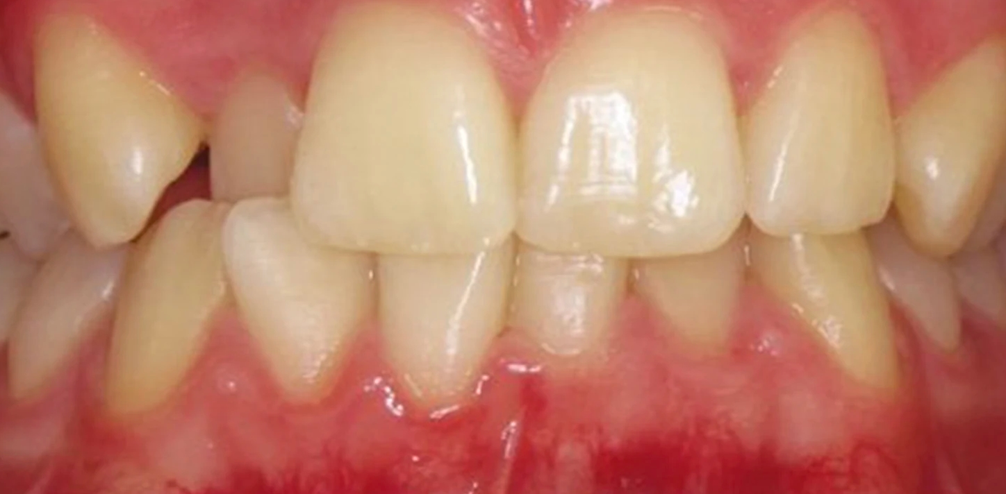 Routine Dentistry before smile
