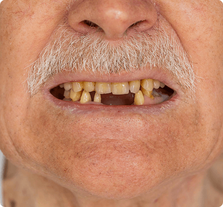 Replace missing gaps & loose dentures