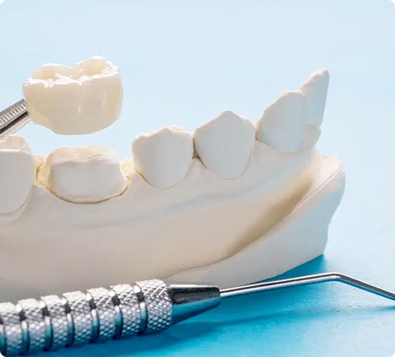 Ceramic Dental Crowns